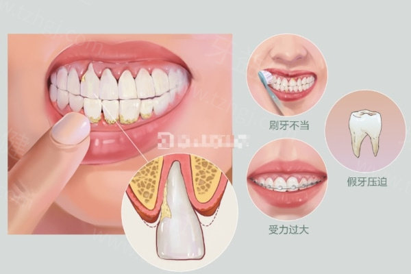 牙龈萎缩早期和晚期的图片对比