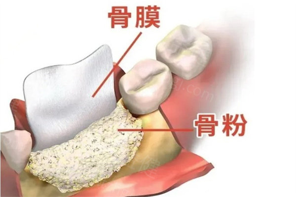 牙科骨粉品牌排行榜分享！附牙科骨粉价格表