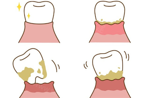32岁女子全口只剩4颗牙!看看不重视牙周炎治疗会导致哪些口腔问题吧