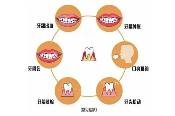 32岁女子全口只剩4颗牙!看看不重视牙周炎治疗会导致哪些口腔问题吧