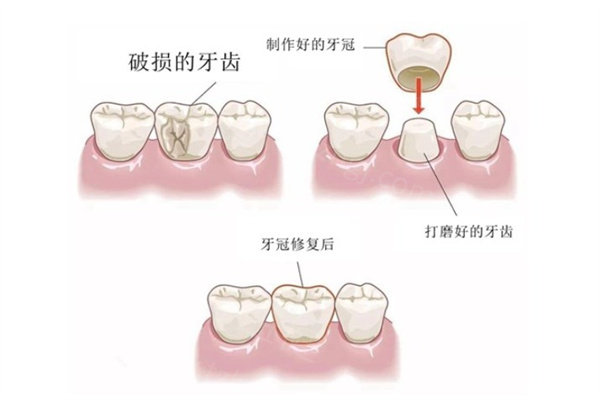 全口活动义齿有几种类型?树脂|金属|全瓷等5种常见类型及优势|适用人群|佩戴体验分享