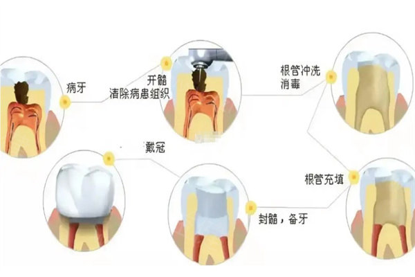 全口活动义齿有几种类型?树脂|金属|全瓷等5种常见类型及优势|适用人群|佩戴体验分享