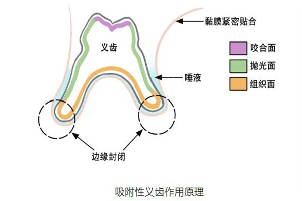 bps吸附性义齿多少钱