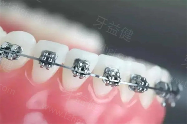 广州天河区牙齿矫正价格一览：金属9200起/隐形15500起/儿童矫正7800起费用不贵