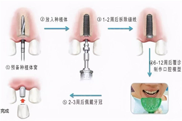 为什么种植牙拔牙后先养牙？种植牙流程步骤了解下