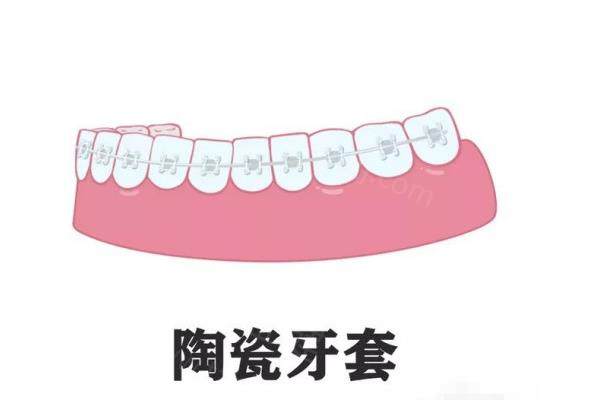 盘点2025年牙套种类以及收费，