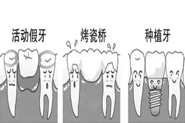 福州活动义齿费用是多少？包含各类镶牙25年全新报价