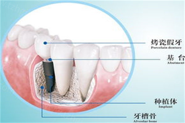 种植牙
