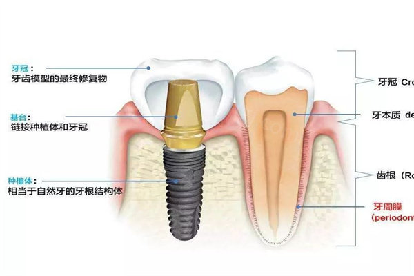 种植牙