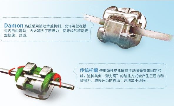 牙齿矫正如何选择合?其实根据脸型/年龄/费用就能制定专属方案