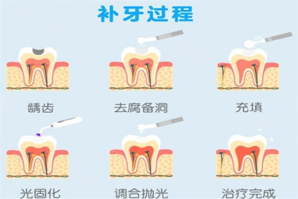 南京牙科医院补牙价格表更新:儿童/成人补牙材料及品牌详细费用分享