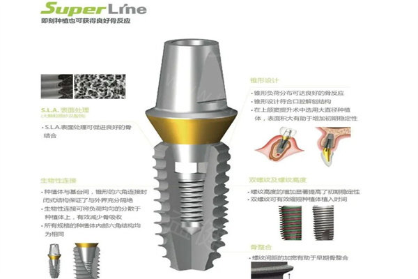 韩国登腾种植牙质量怎么样：国内常用十大植体性价比之选到底靠不靠谱？