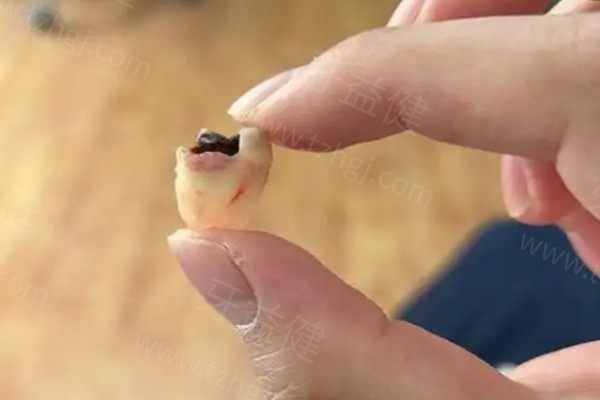 长沙拔牙齿一般多少钱？关于简单拔出+复杂智齿不同价位展示
