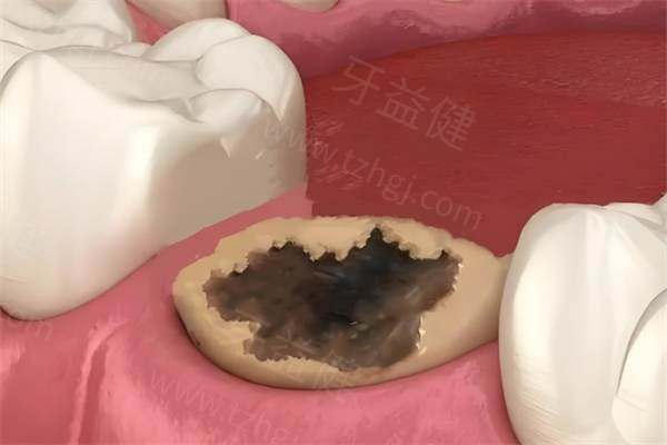 拔智齿费用