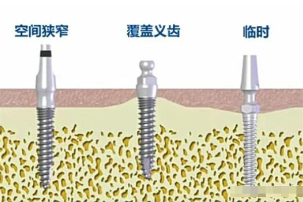 南京口腔医院种植牙收费标准:单颗2400+半口种牙2w+全口即刻种植6w+附医院排名