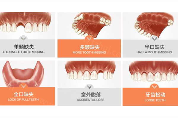 上海种一颗牙大概需要多少钱 上海种一颗牙大概需要多少钱