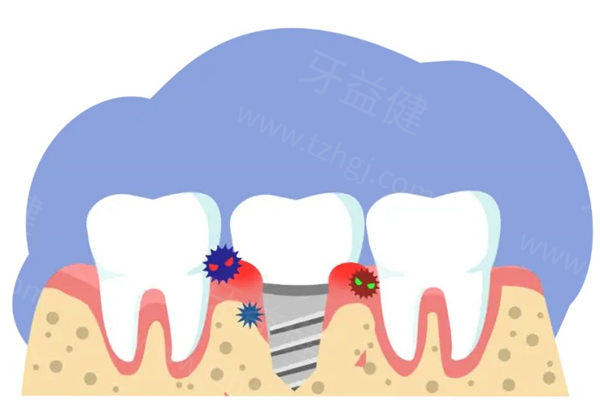 老年人种植牙十大品牌深度解析：材质、技术特色、价格全对比，助您选对方案