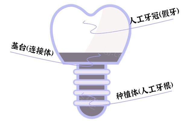 长春种植牙多少钱一颗2026价格表
