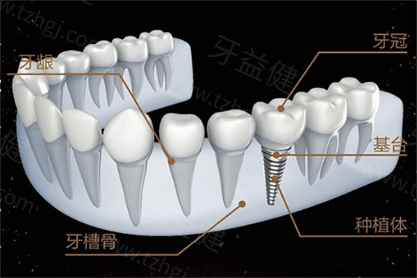 杭州种植牙多少钱一颗?看清收费明细与主流口腔机构实力解析