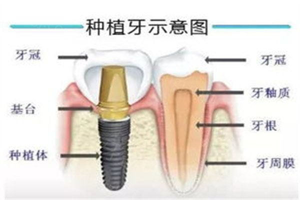 杭州种植牙价格 杭州种植牙价格