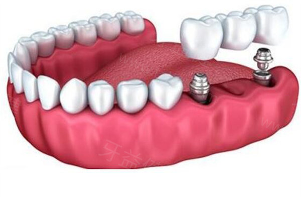 种植牙价格 种植牙价格
