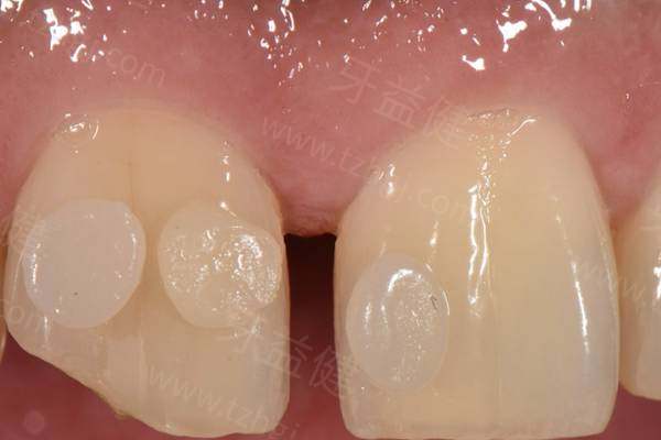 为什么不建议树脂补门牙缝?门牙缝修复需兼顾美观持久,树脂材料恐难胜任