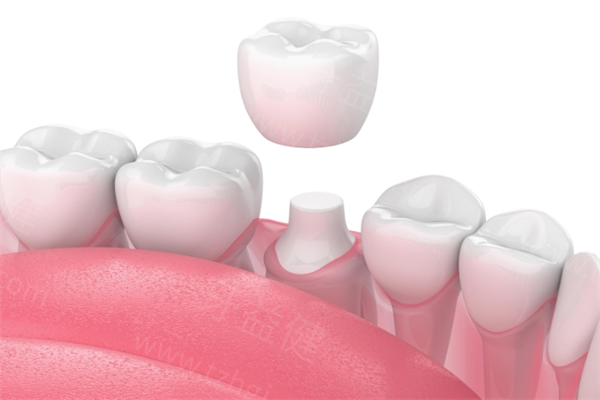 做过牙冠的牙根断了怎么办?看是否能保留压根