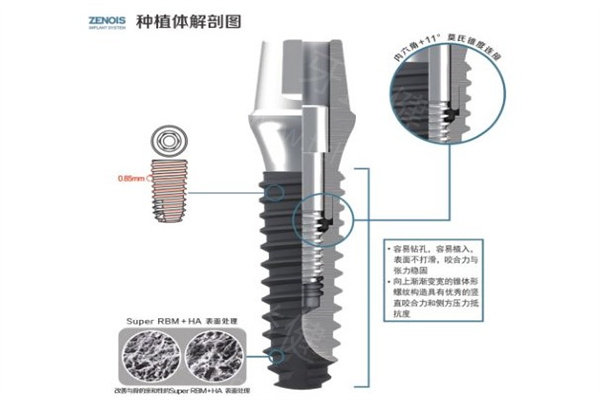 破大防!2026北京正规口腔医院种植牙价格又降了!单颗1800元起/半口1.6w元起/全口即刻5w起劲松中诺拜博等技术排前三