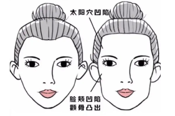 戴牙套脸凹了要紧吗